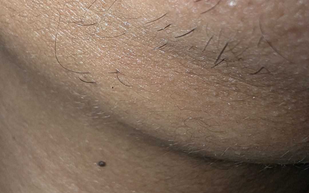 Hair on chin or hirsutism, cystic acne or acne vulgaris and two skin tags on the face of a woman diagnosed with a hormonal imbalance caused by Polycystic Ovarian Syndrome or PCOS. These symptoms are most likely due to high androgen and testosterone in the woman's blood.